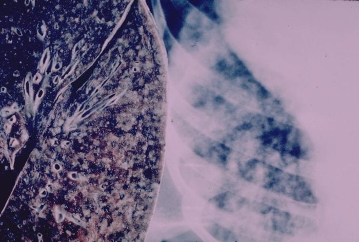 A close up of a human lung on the left with part of an x-ray of human ribcage on right