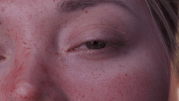 A closeup of Penelope's face, featuring a number of bug bites